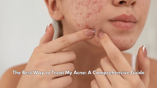 The Best Way to Treat My Acne: A Comprehensive Guide