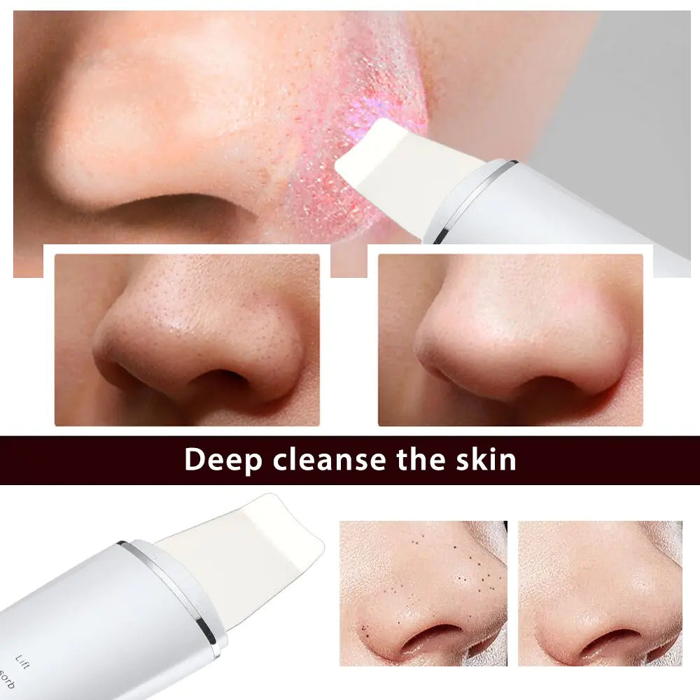 Ultrasonic Skin Scrubber Blackhead Remover